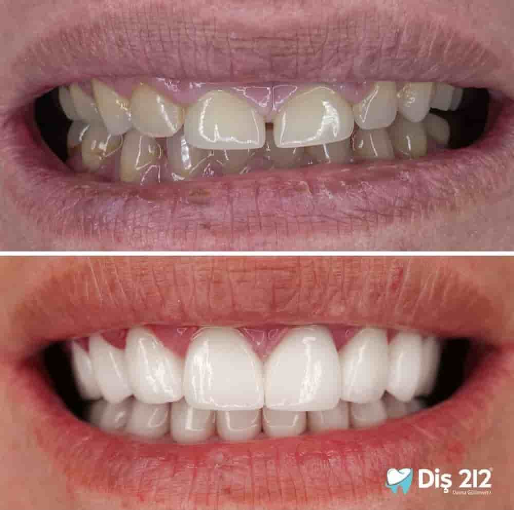 Подтвержденные отзывы пациентов о Dis 212 - Dental Aesthetics Facility в Istanbul, Turkey Slider image 5