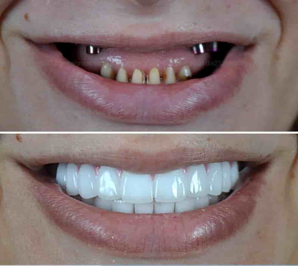 Подтвержденные отзывы пациентов о Dis 212 - Dental Aesthetics Facility в Istanbul, Turkey Slider image 6