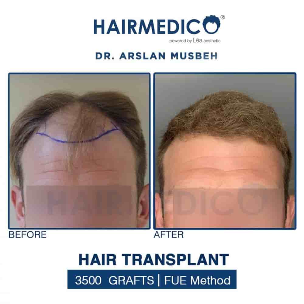 Подтвержденные отзывы пациентов о Hairmedico в Istanbul, Turkey Slider image 1