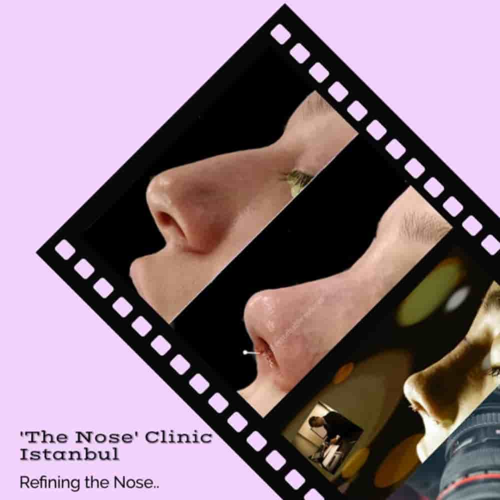 Подтвержденные отзывы пациентов о The Nose Aesthetic Clinic в Istanbul, Turkey Slider image 3