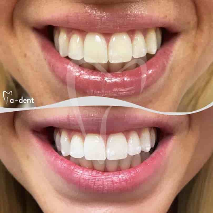 Подтвержденные отзывы пациентов о A-dent Dental Clinic в Antalya, Turkey Slider image 4