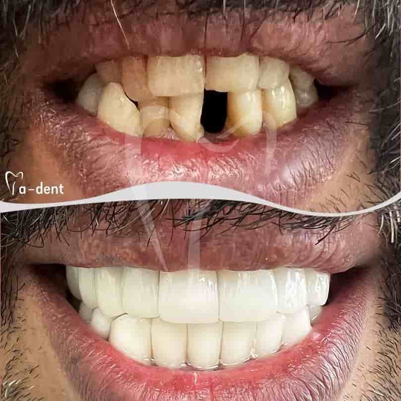 Подтвержденные отзывы пациентов о A-dent Dental Clinic в Antalya, Turkey Slider image 7
