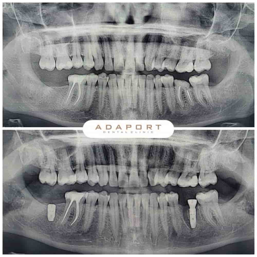 Подтвержденные отзывы пациентов о Adaport Dental Clinic в Izmir, Turkey Slider image 2