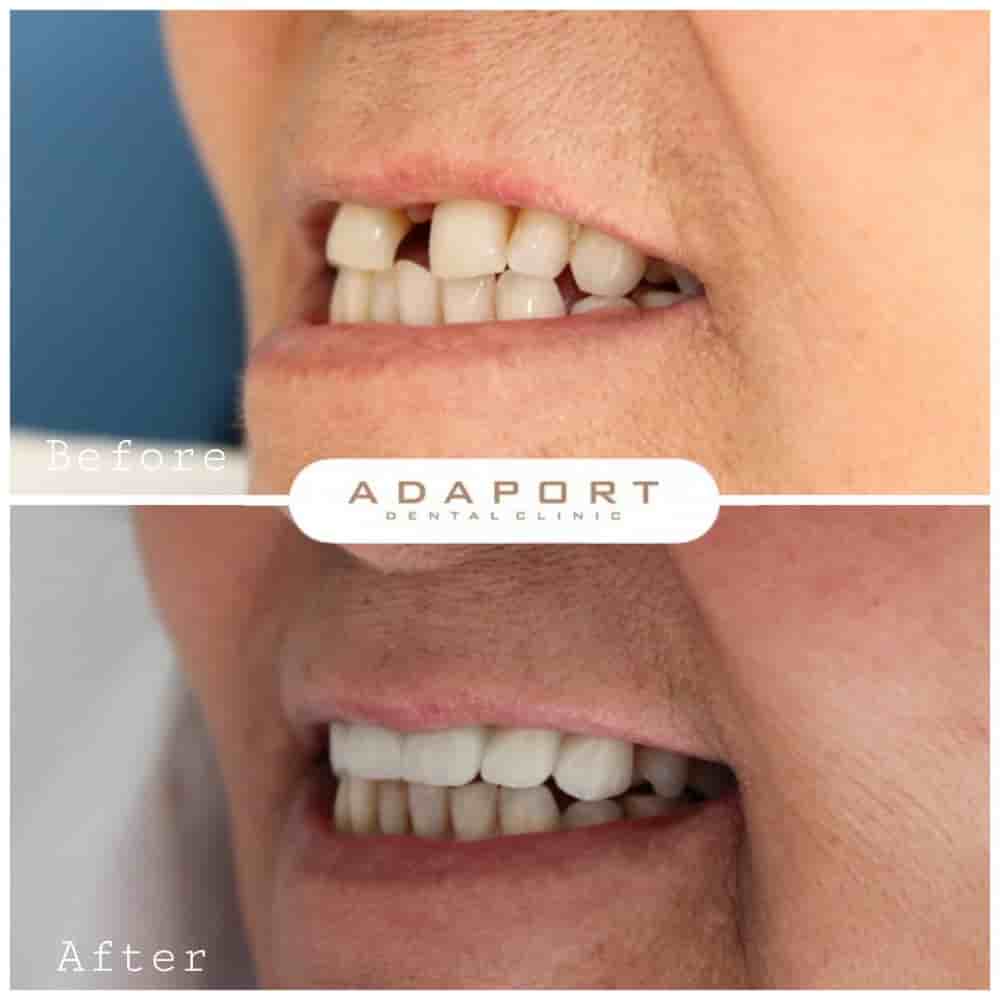 Подтвержденные отзывы пациентов о Adaport Dental Clinic в Izmir, Turkey Slider image 3