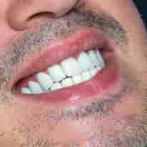 Подтвержденные отзывы пациентов о Turkiye Dental в , Turkey Slider image 8