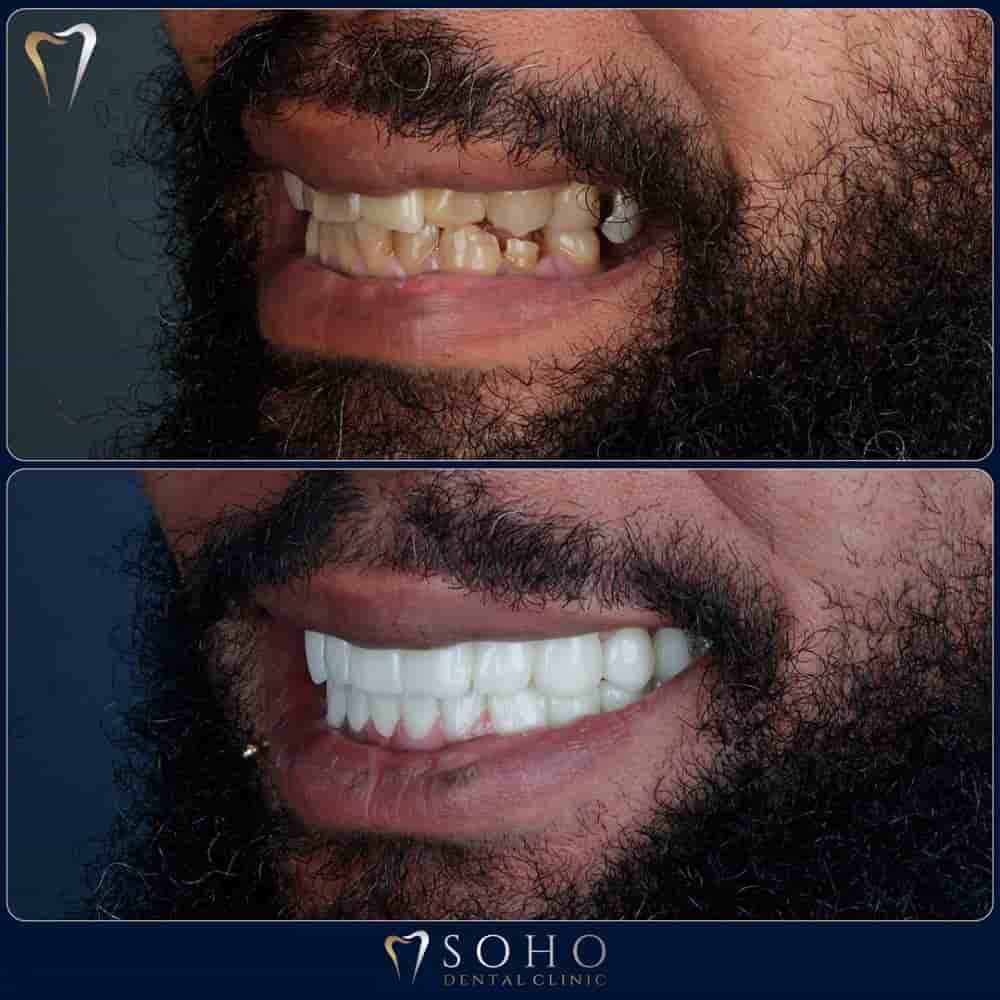 Подтвержденные отзывы пациентов о Soho Dental Clinic в Istanbul, Turkey Slider image 9