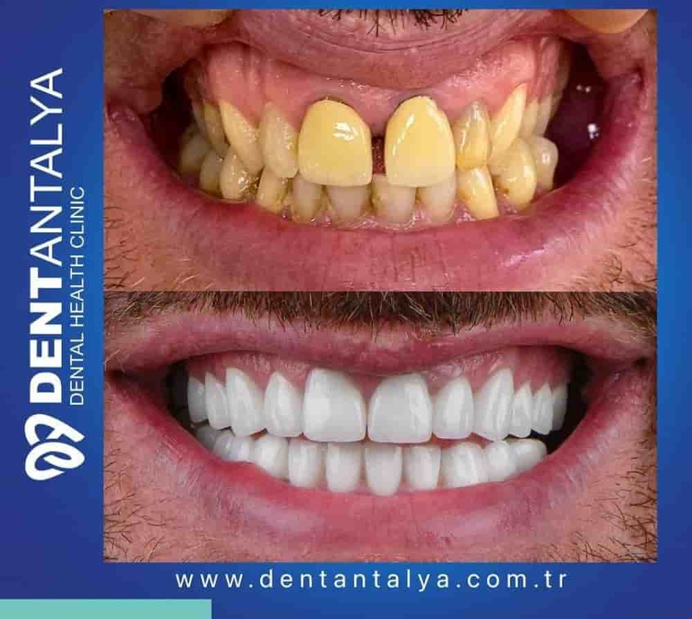 Подтвержденные отзывы пациентов о Dent Antalya в Antalya, Turkey Slider image 9