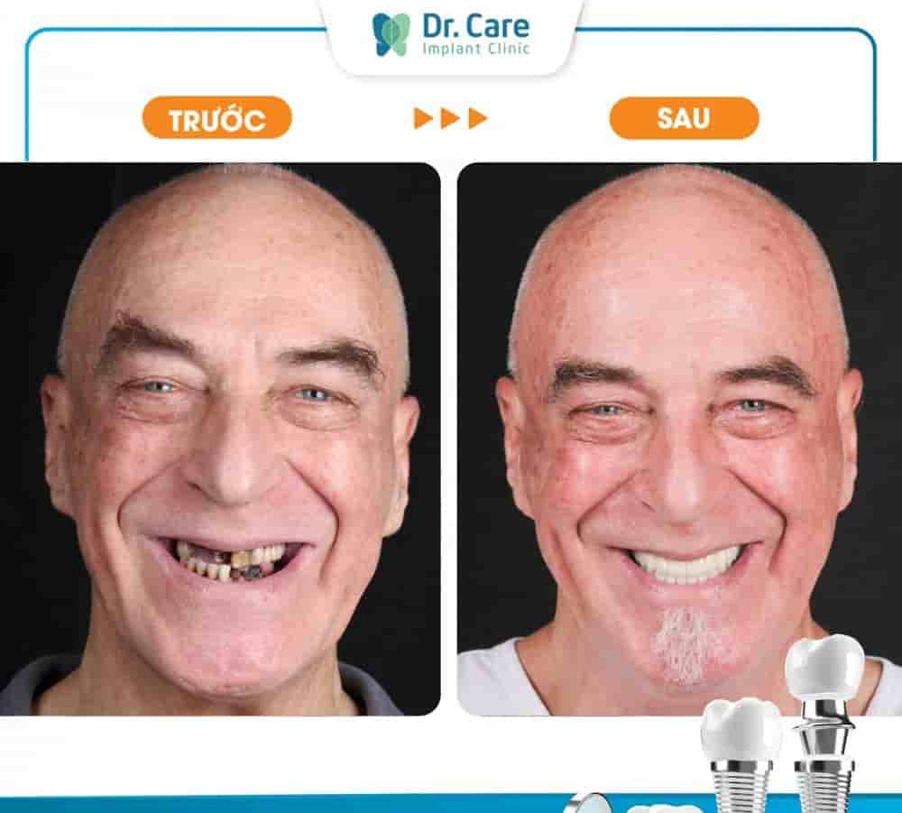 Подтвержденные отзывы пациентов о Dr. Care Implant Clinic в Ho Chi Minh, Vietnam Slider image 3