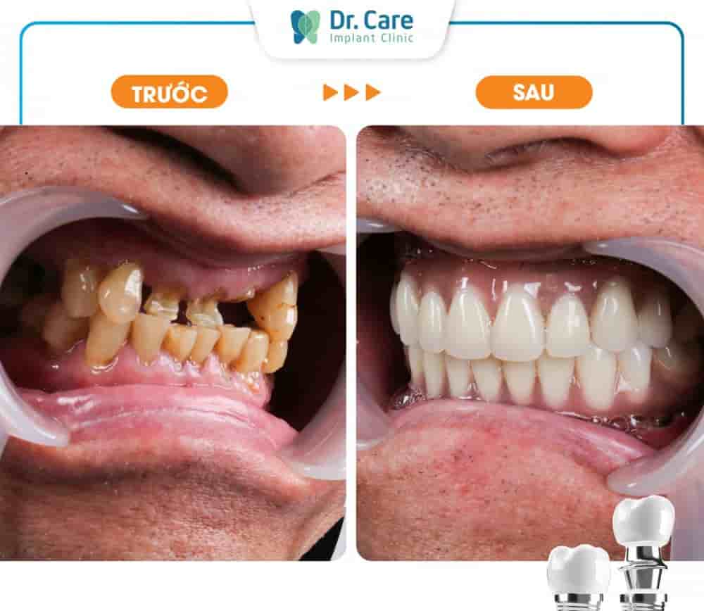 Подтвержденные отзывы пациентов о Dr. Care Implant Clinic в Ho Chi Minh, Vietnam Slider image 6