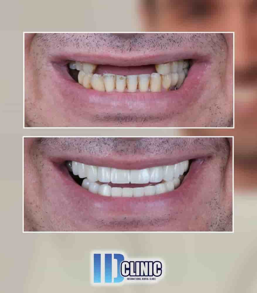 Подтвержденные отзывы пациентов о IDC International Dental Clinic в Antalya, Turkey Slider image 1