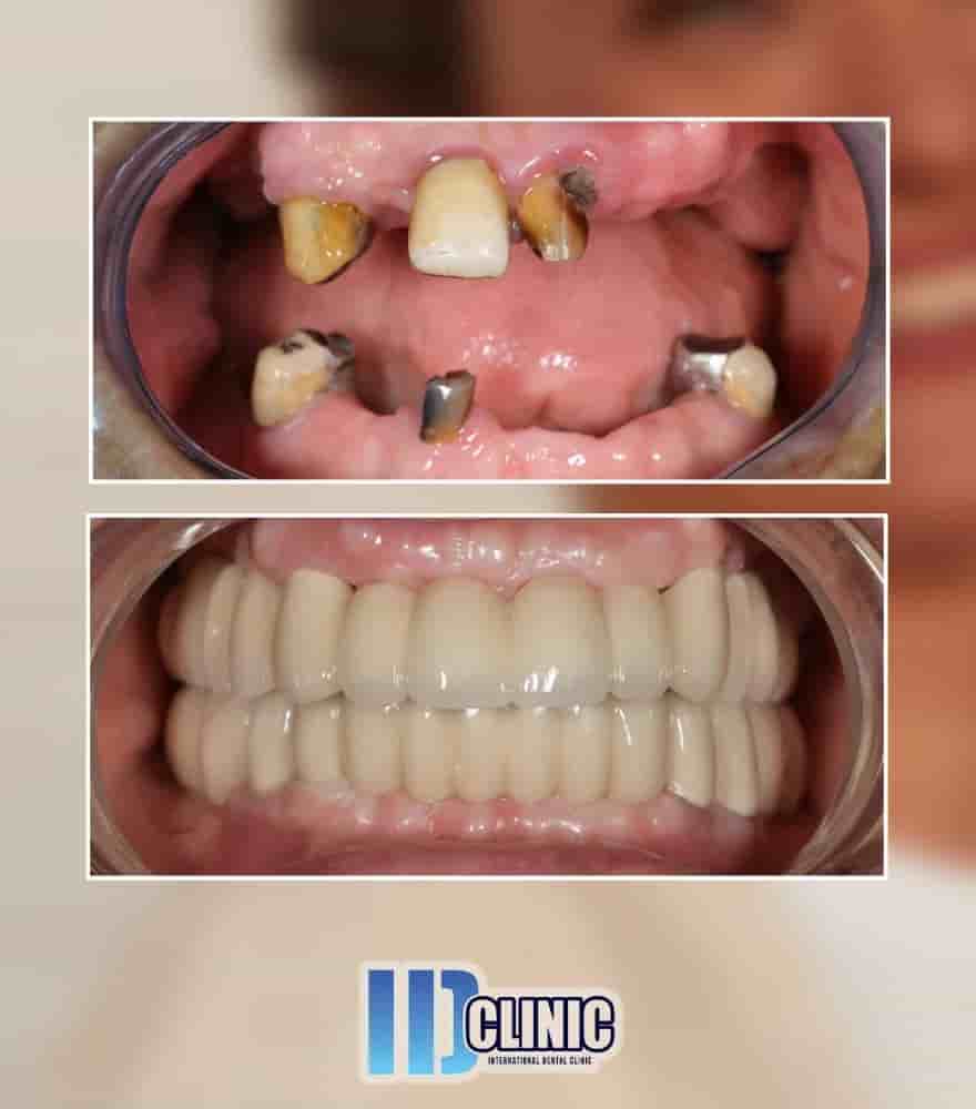 Подтвержденные отзывы пациентов о IDC International Dental Clinic в Antalya, Turkey Slider image 2