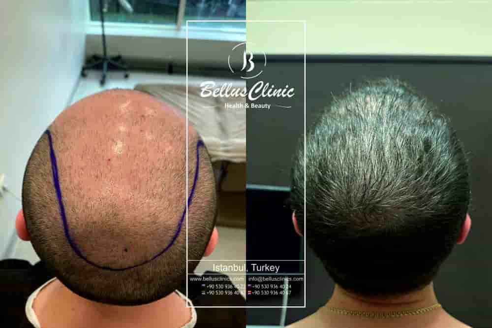 Подтвержденные отзывы пациентов о Bellus Clinic в Istanbul, Turkey Slider image 7