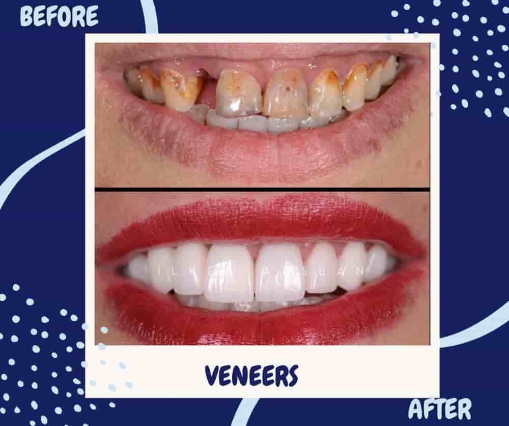 Подтвержденные отзывы пациентов о Universe Dental - Best Dental Clinic in Tbilisi, Georgia в Tbilisi, Georgia Slider image 4