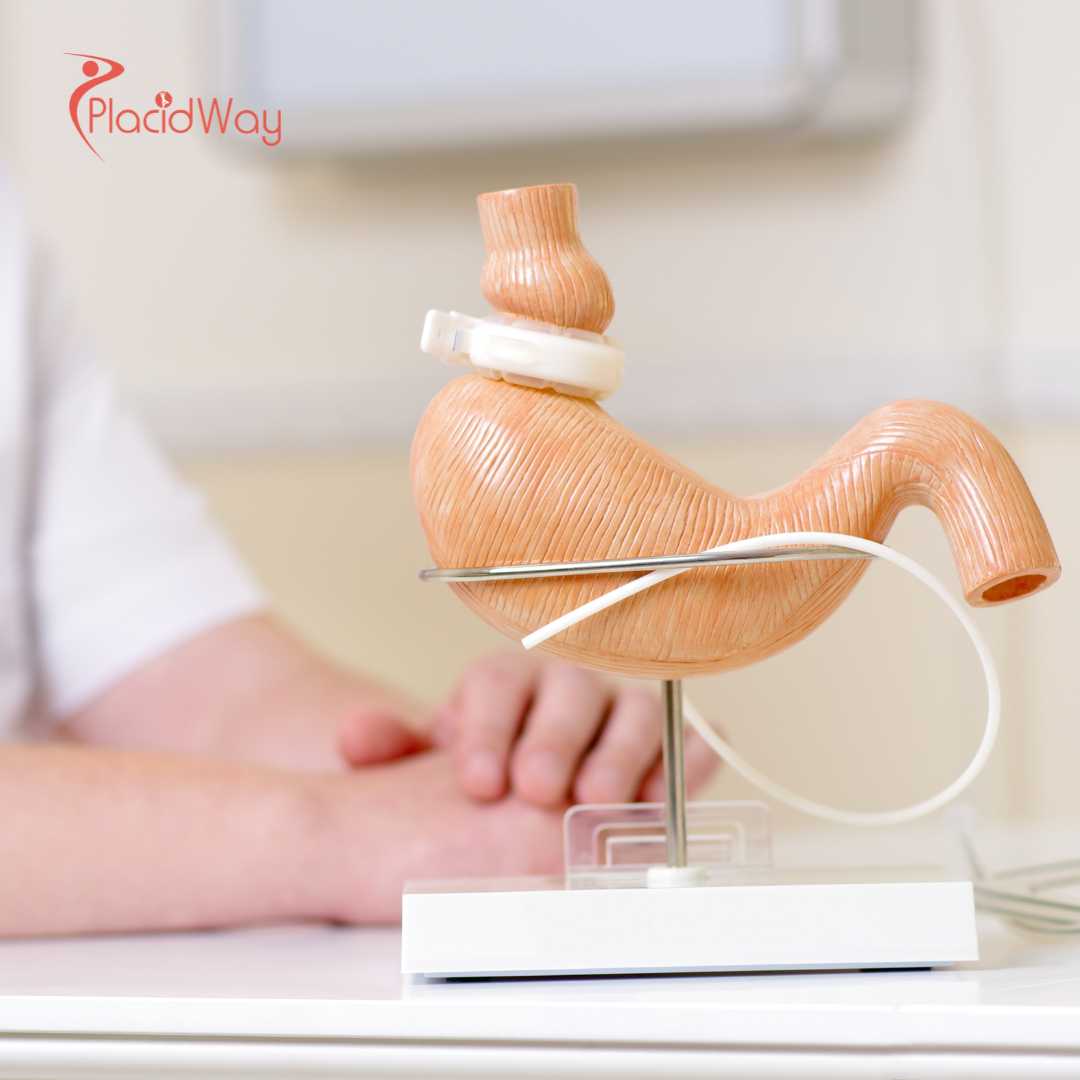 Повторная бариатрическая хирургия в Турции для пациентов, возобновляющих свой путь к снижению веса.