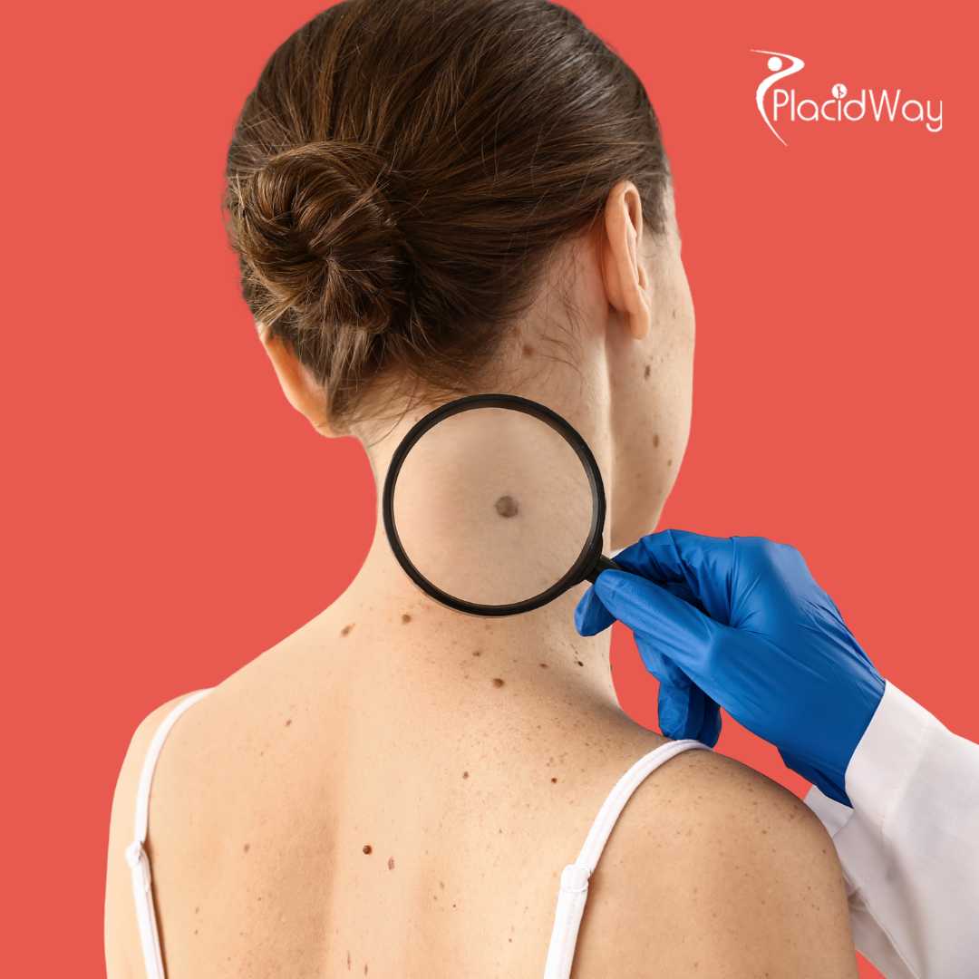 Иммунотерапия в Китае: терапия меланомы с помощью TIL