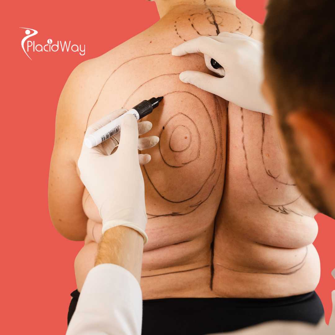 Липосакция в Южной Корее