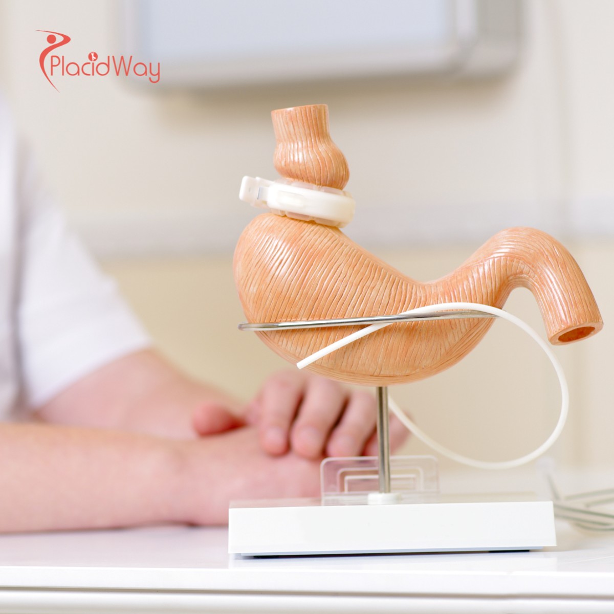 Повторная бариатрическая хирургия в Турции для пациентов, возобновляющих свой путь к снижению веса.