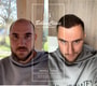Пересадка волос методом FUE в клинике Bellus Clinic — верните себе волосы с клиникой Bellus Clinic thumbnail